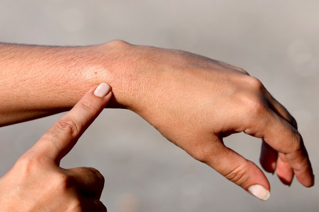 An image of a person pointing to a sting mark on their wrist